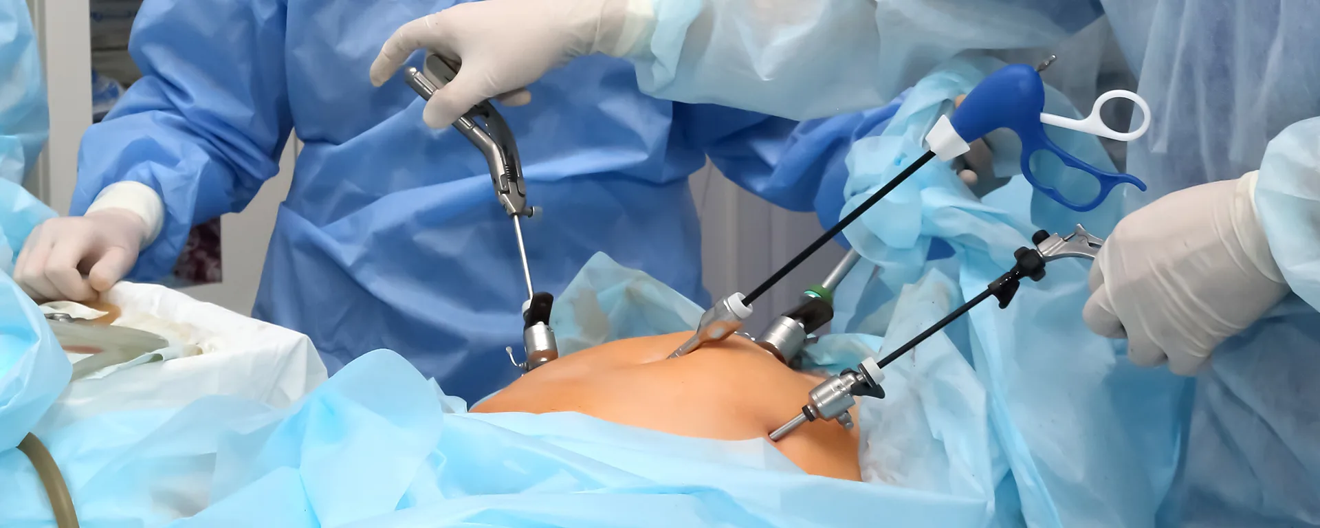 Best Diagnostic Laparoscopy in Surat